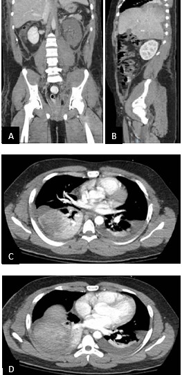 (A and B) Coronal and CT of the chest and pelvis showcasing right herniation of the liver into the thoracic cavity; (C and D) Transverse CT of the right herniation of the liver into the thoracic cavity.