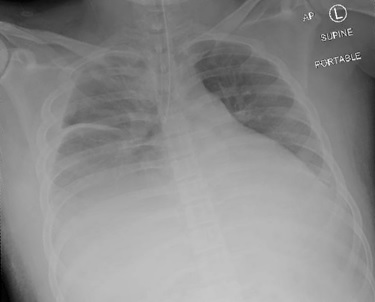 Intra-operative chest X-ray showcasing the endotracheal tube in the right main bronchus.