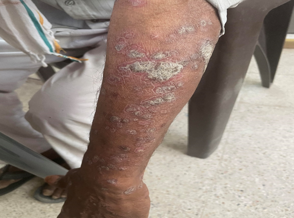 Showing Psoriatic plaque