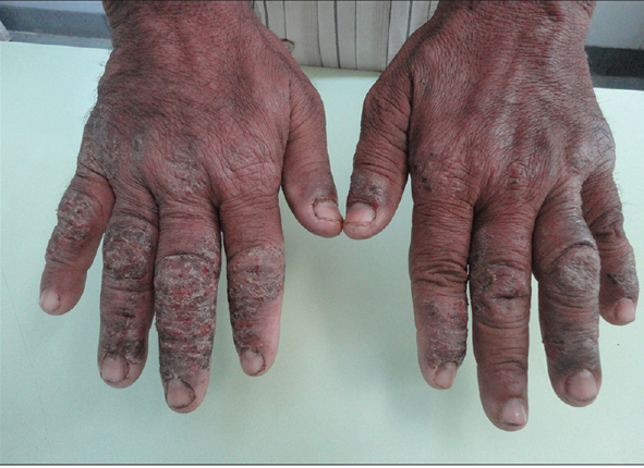Showing contact dermatitis in cement worker