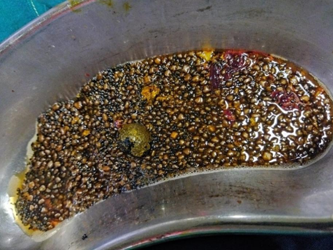 7,228 gall stones removed through laparoscopic cholecystectomy