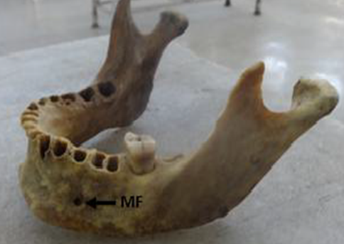 Showing the mental foramen in between 2nd premolar and 1st molar teeth. MF- Mental foramen