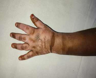 Wound at time of discharge