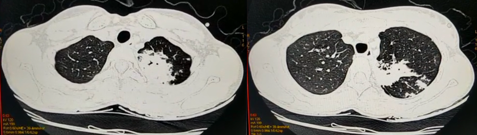 HRCT Thorax (Lung Window)