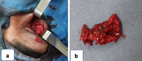 Intraoperative picture with specimen.