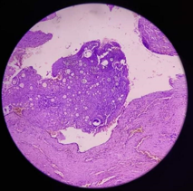 Histopathology showing the typical sporangia containing numerous spores