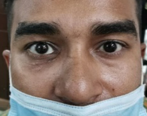 Postoperative (Patient on 6 months follow up).