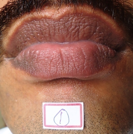 Photograph of subject lips cleaned thoroughly for lip print Estimation.