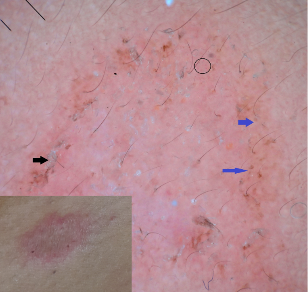 Clinical and dermoscopic image of PR showing scaling (black arrow) red dots (black circle), brown globules (blue arrow) and pinkish background