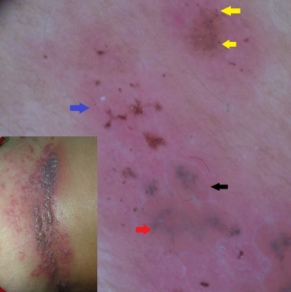 Clinical and dermoscopic image of hepes zoster with black arrow showing polylobular white structure (border), blue arrow showing Erythematous background, yellow arrow showing brown dots and red arrow showing grey to black central structure
