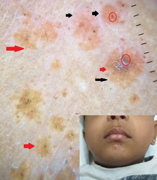 Clinical and dermoscopic image of hand foot and mouth disease showing brown dots, globules (red circle), yellowish/brown background (red arrow), crusting and whitish hue (black arrow)