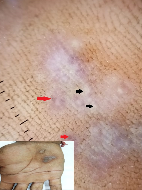 Clinical and dermoscopic image of orf nodule showing bluish globules (red arrow) and whitish areas (black arrow)