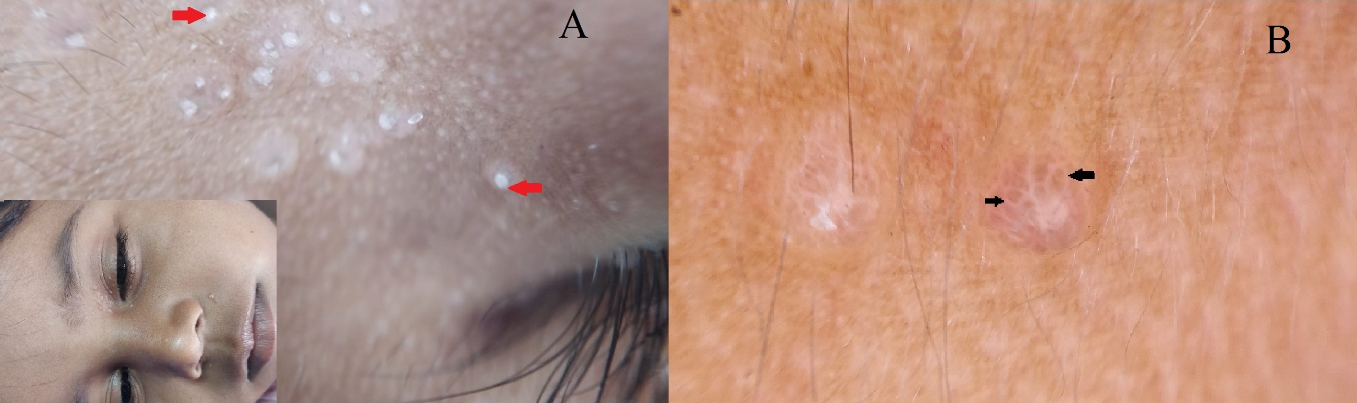 Dermoscopic image of molluscum contagiosumshowing white amorphous structure (A) and polyglobular structure (B)