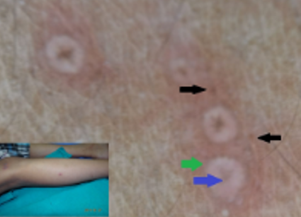 Clinical and dermoscopic image of chicken pox with black arrow showing brown dots, blue arrow showing central umbilication and green showing erythematous background