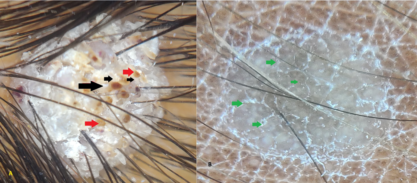 Dermoscopic image of common wart (A) showing tadpole like structure, red dots (red arrow) with white halo (black arrow) and plane wart (B) showing black dots