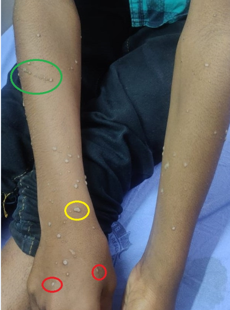 Clinical image showing plane wart (red), common wart (yellow) and koebnerization (green)