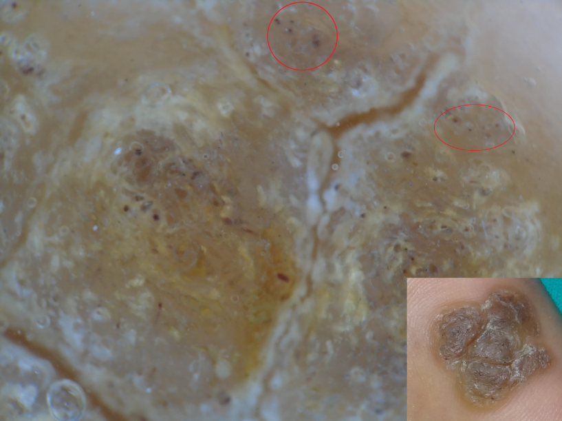 Clinical and dermoscopic image of plantar wart showing black dots