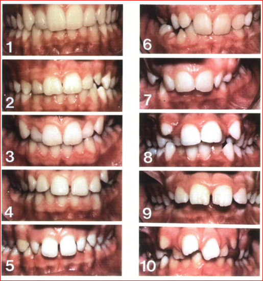 Aesthetic component of index of orthodontic need