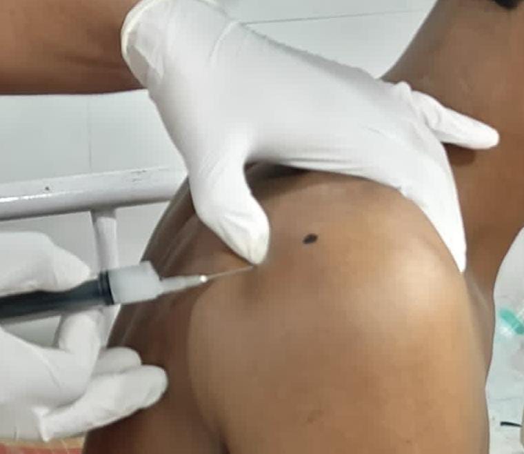 Administration of intraarticularCorticosteroid injection for Periarthritis shoulder
