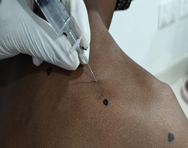 Technique of supra scapular nerve block