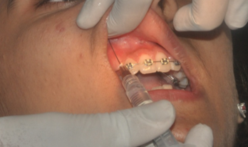 Administrationof local anaesthesia