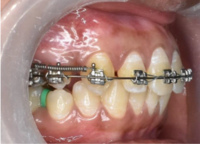 Maxillary canine retraction in progress using a NiTi closing coil spring