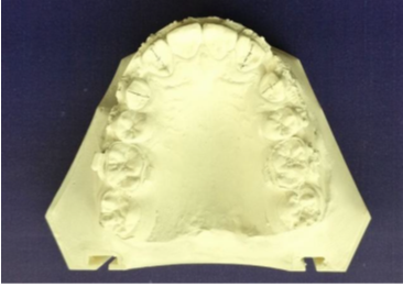 Cast with markings for measurement of canine retraction