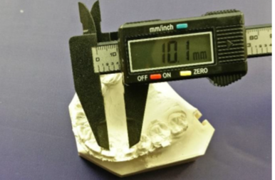 Measurement of canine retraction using digitalcaliper