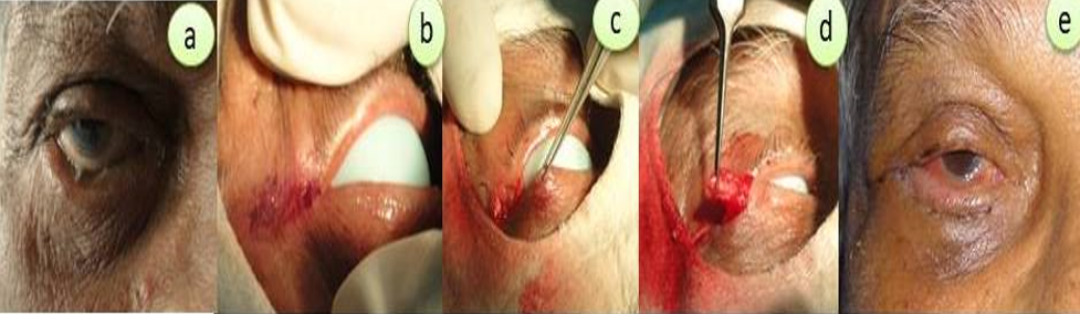 (a-e): a. Involutinal Entropion of right lower eyelid, b. Marking Lateral canthotomy incision, c. Inferior canthotomy and cantholysis, d. Making a lateral strip, and e. Immediate postoperative status and restoration of right lower eyelid marginal position.