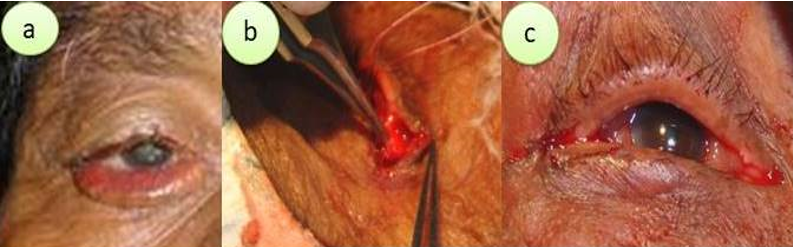 (a-c): Involutional ectropion of the right lower eyelid, the lateral tarsal strip (LTS), restoration of lower eyelid position after LTS procedure