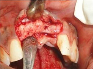 Bucco-lingually deficient bone 21 region