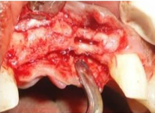 Alveolar ridge after bone spreading with osteotomes 21 region