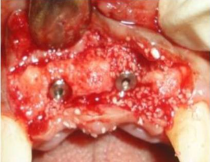 Implants in place with 11 and 21 region