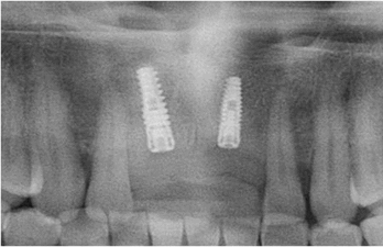 Eight months postoperative radiograph