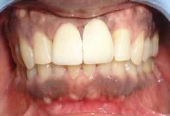 Prosthetic rehabilitation with PFM crowns