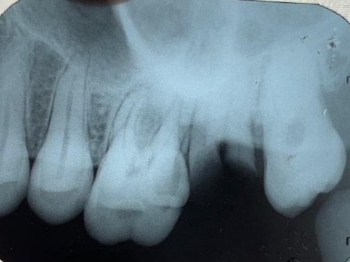 Shows preoperative radiograph of left maxillary 1st molar