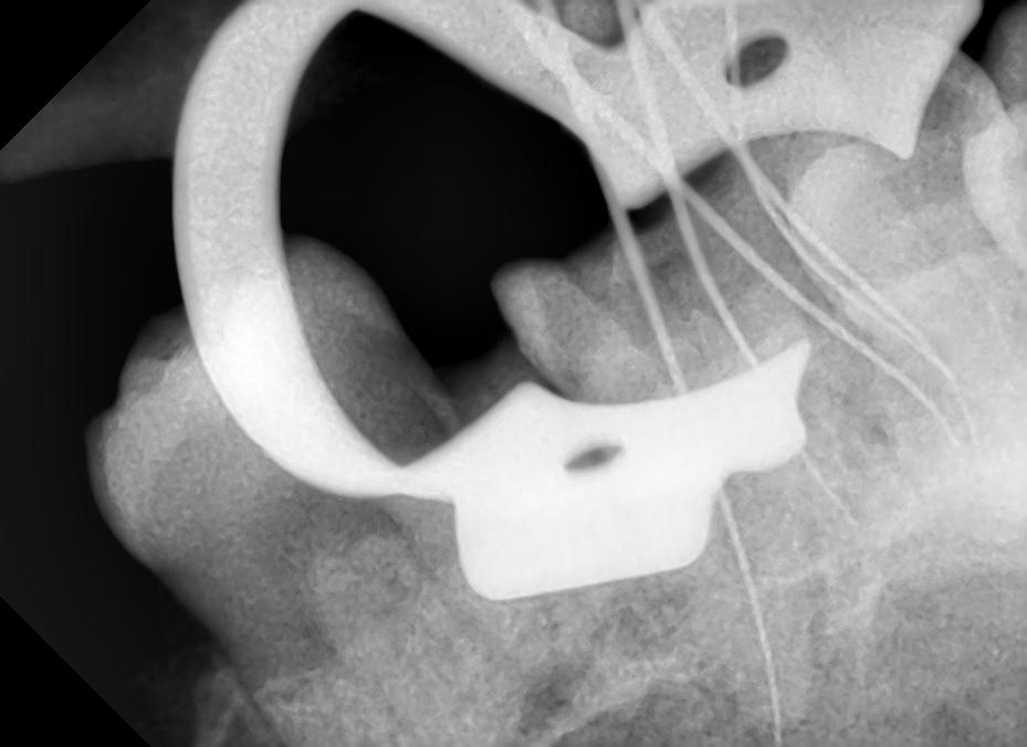Intraoral periapical radiograph shows working length