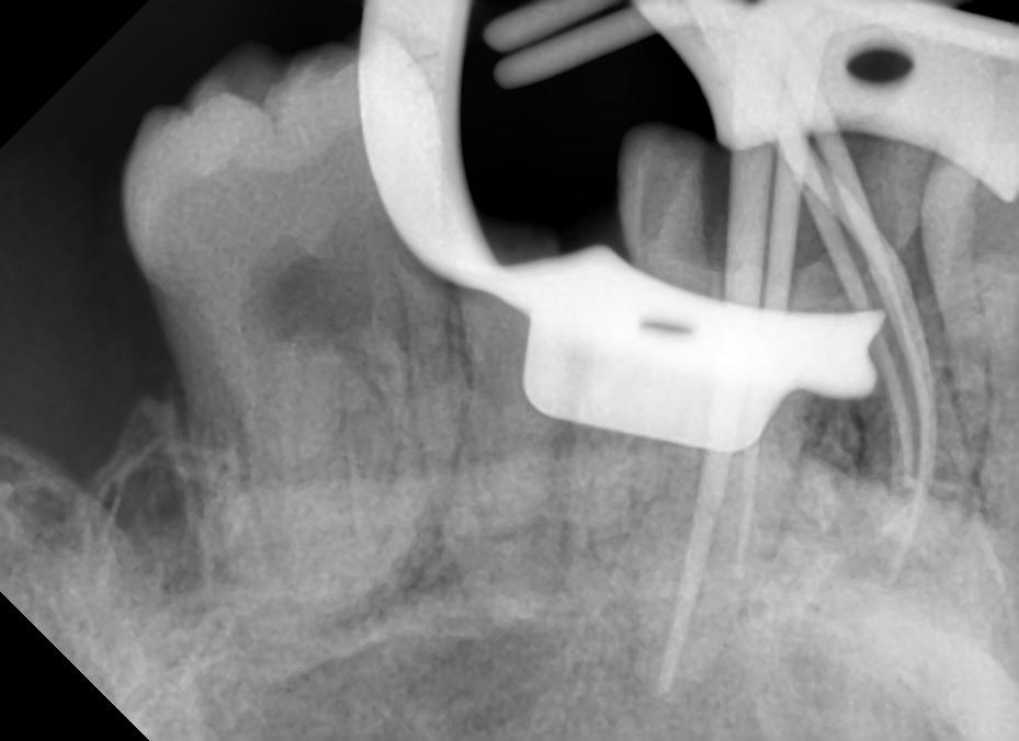 Intraoral periapical radiograph shows master cone