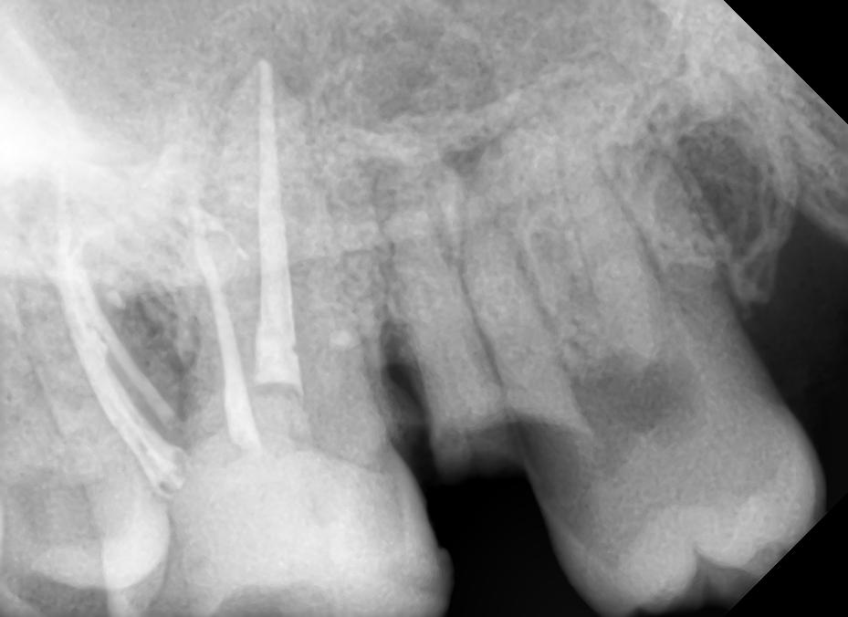 Intraoral periapical radiograph obturation and post obturation restoration