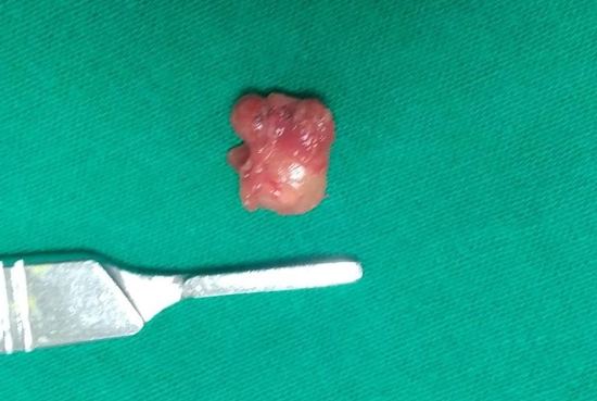 Excised lymph node