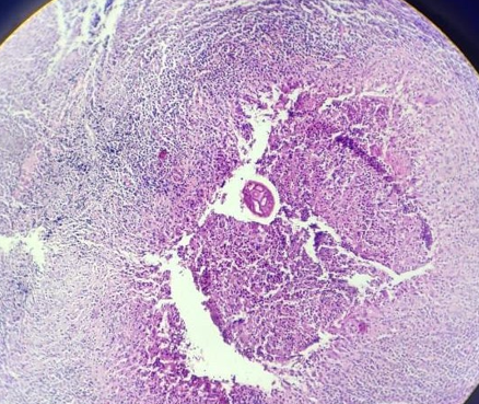 2 : Histopathology showing cut section of filarial worm surrounded by eosinophilic abscess and marked fibrosis