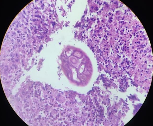High power view showing cross section of Filarial worm