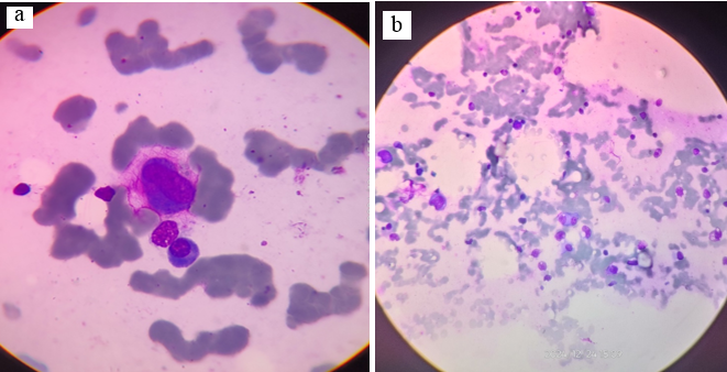 a,b: Bone marrow aspiration showing dyselectropoiesis (megaloblastic changes, multinucleation)