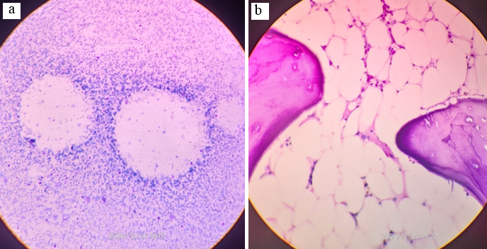 a,b: Bone marrow shows grossly reduced cellularity with increased fat spaces, without any malignant cell or granuloma