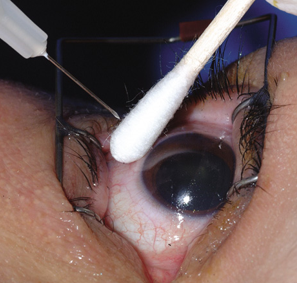 Procedure of Vitreous aspiration