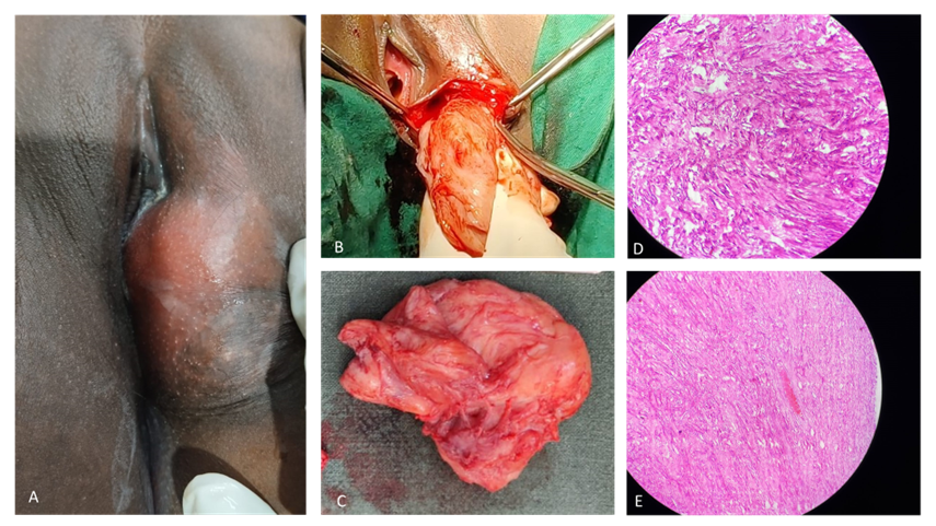 A): Vulval mass over left labia majora, B): Mass excision, C): Gross morphology of the angiofibroma, D and E): Histopathology slide – spindle cells and medium sized vessels