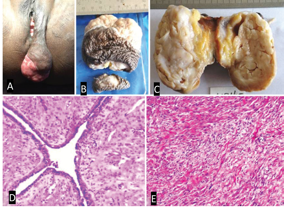 A): Pedunculated mass in left labium majus, B): Gross specimen - skin with nodular mass and separate peduncle, C): Cut section – grey white with slit like spaces, D): Histopathology – leaf like architecture, E): Spindle celled stroma with collagen bands.