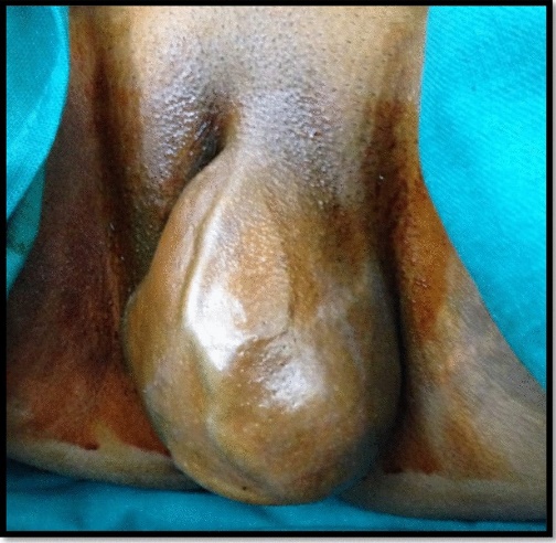 Gross appearance of vulval swelling in left labium majus