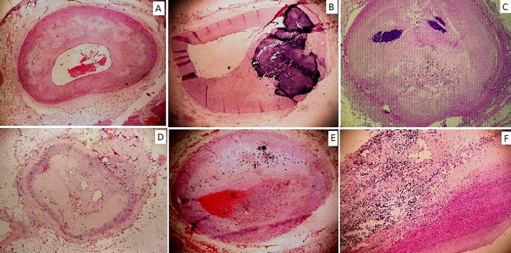 Microscopic changes in coronaries; A, B and C show variable grades of atherosclerosis with calcification, D show neovascularisation, E show mural thrombus formation, F show metastatic deposits in aorta (H&E 100x)