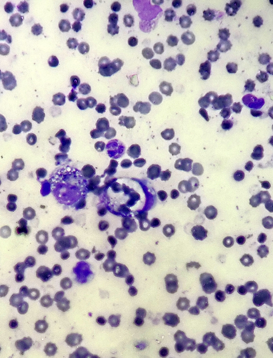 Peripheral blood smear of an Indian male in his early 30s, A histiocyte engulfing a stack of mature RBCs(Leishmans stain, 400 X).